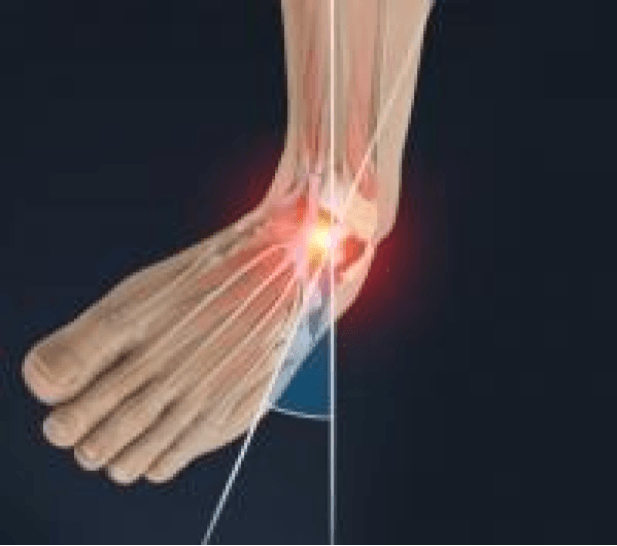 Ankle Sprain or Ligament Injury Bunbury Foot & Ankle Surgeon