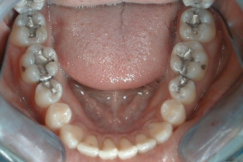 4 Ways Tooth Fillings Can Loosen