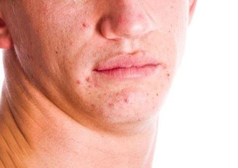 Trattamento per acne