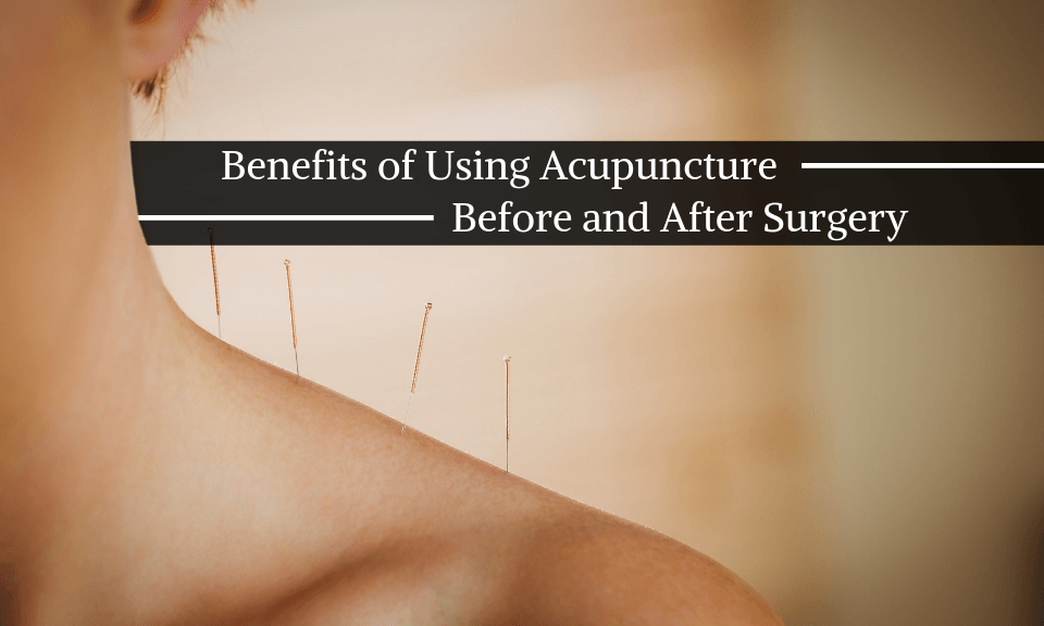 Benefits of Using Acupuncture Before and After Surgery