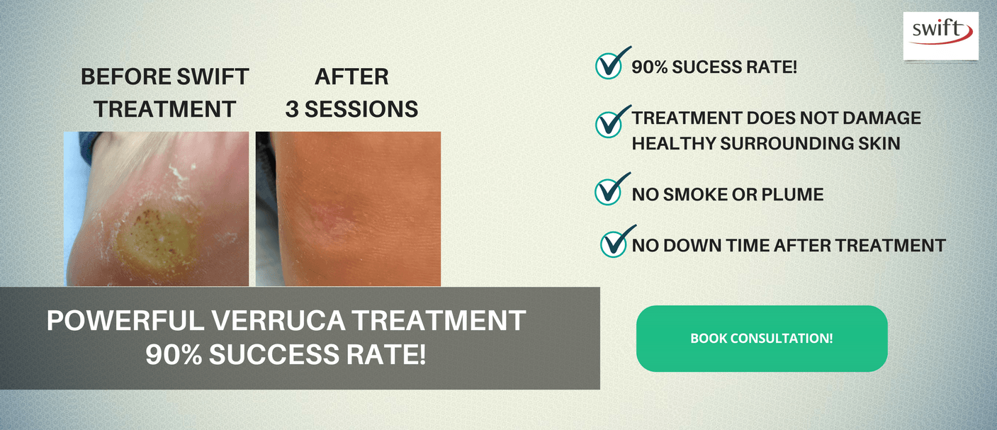 New Swift Microwave Verrucae Therapy