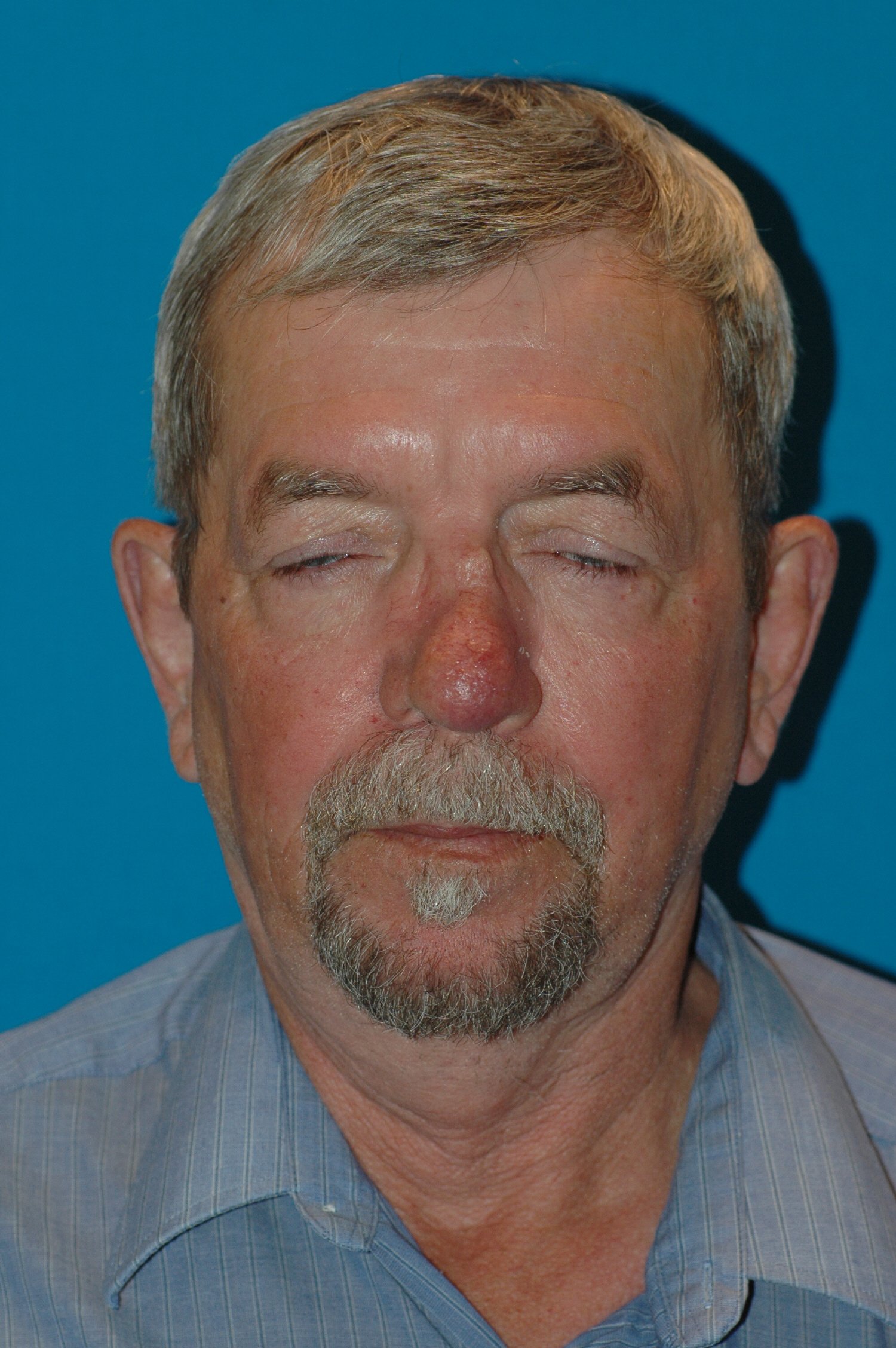 62 Year Old Male Rhinoplasty for Appearance and Breathing Improvement