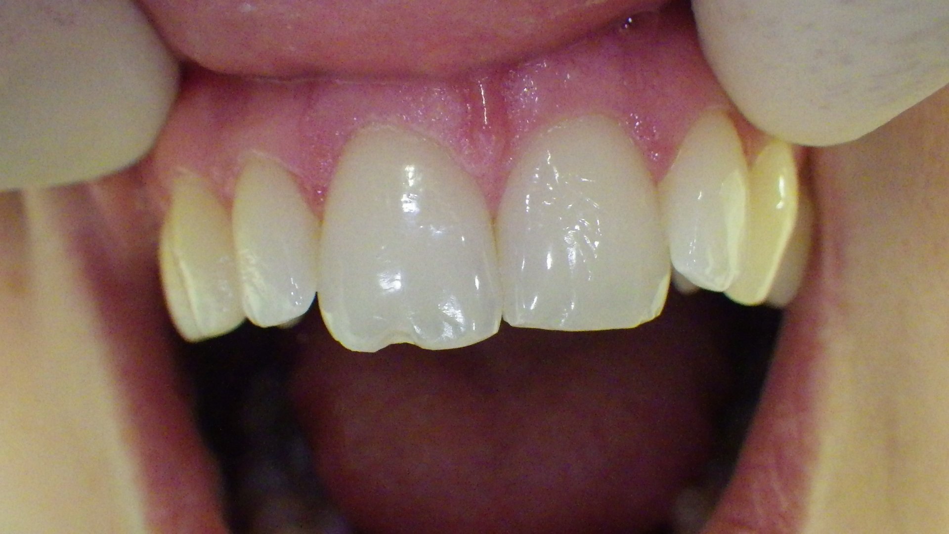 Wie Lange Dauert Zahn Abschleifen Für Krone Zahnarztpraxis Dr. Frank Lobeck in Köln - Dellbrück