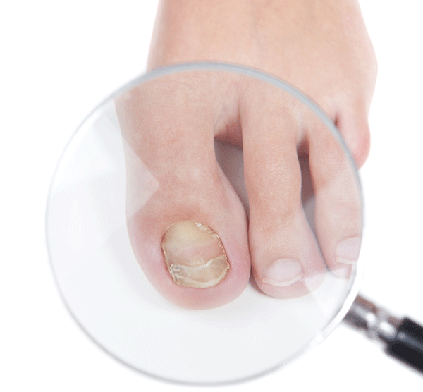 Toenail Fungus Treatment Knoxville TN Knox County Fungal Toenail Removal