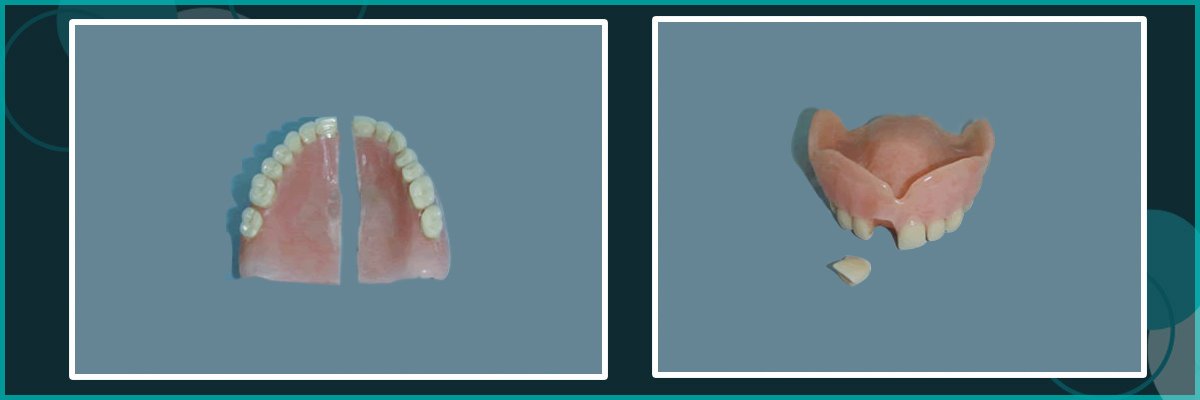 Dentures that need our denture repairs in Belmont