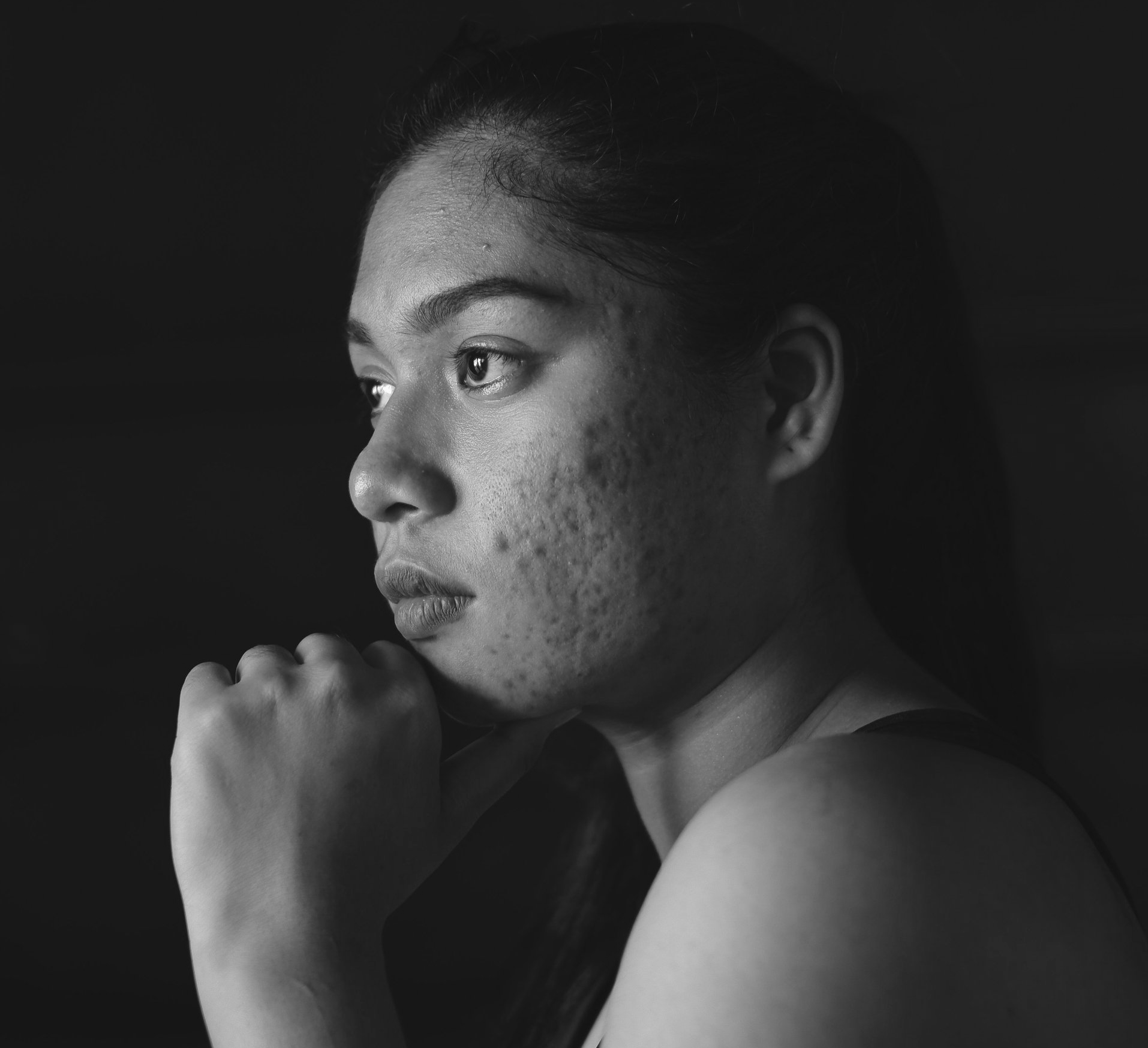 Accutane: A Doctor'S Nightmare, My Reality - pw67pub