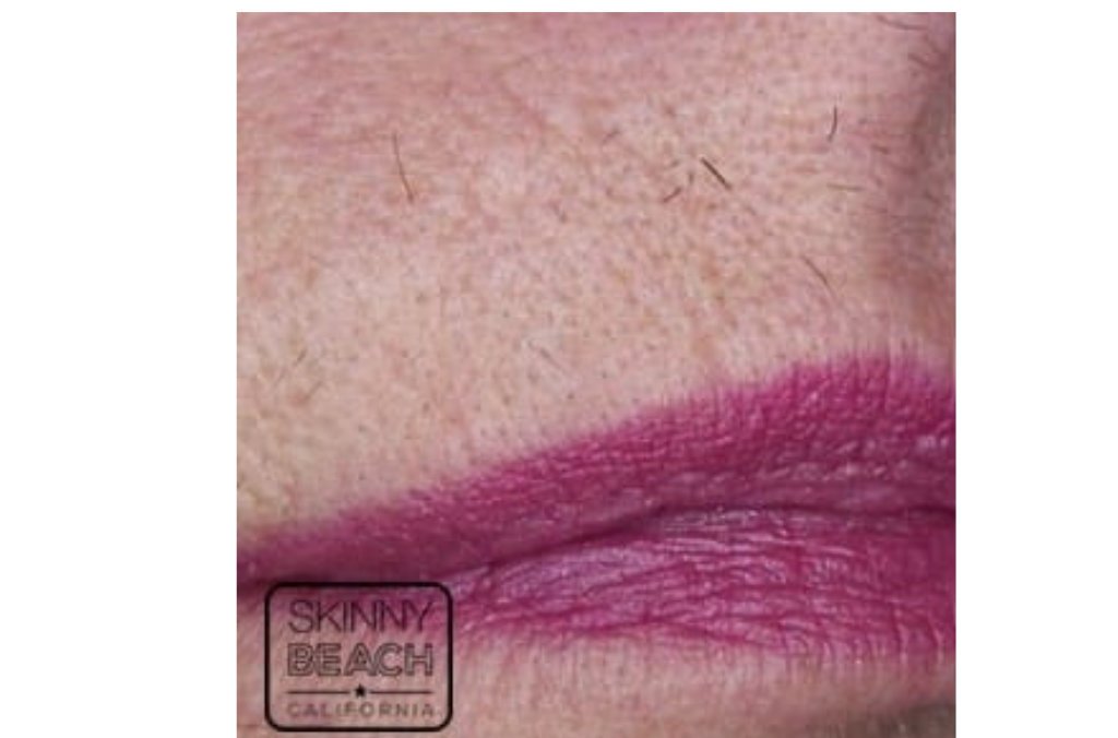 Clarity Laser Treatment San Diego Skin and Hair Removal CA