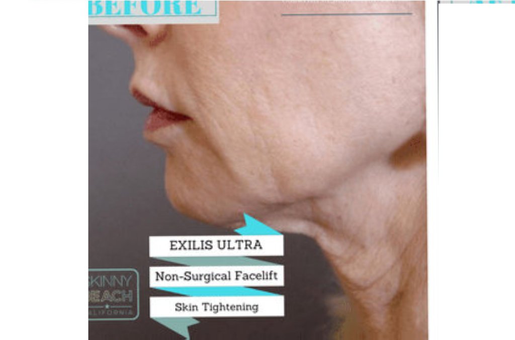 Exilis Ultra NonSurgical Face Lift San Diego Skin Tightening CA