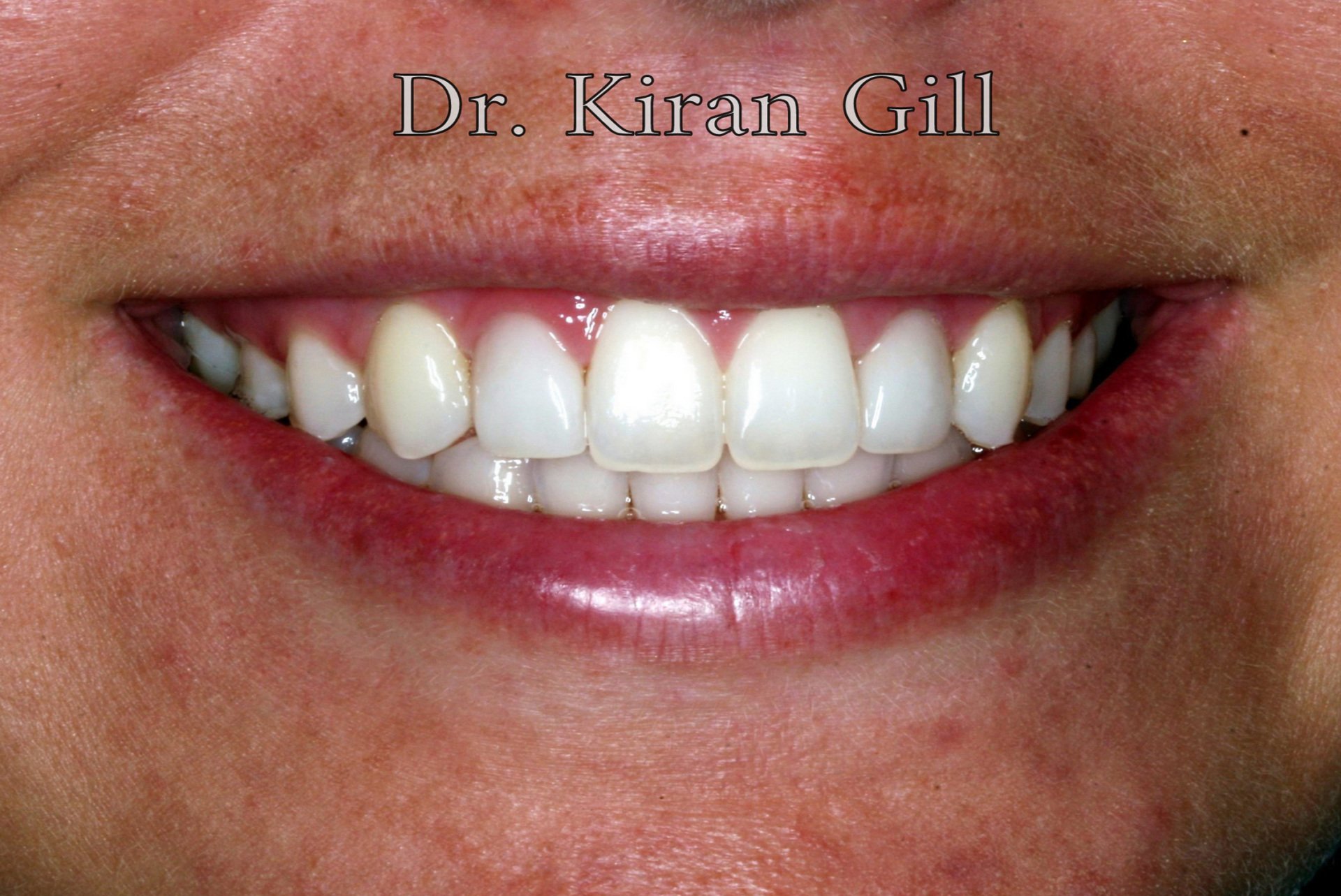 General, Cosmetic & Family Dental Clinic In Louisville, KY Natural Smiles