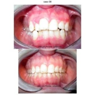 agenesia+bambini+dente+fuso+1