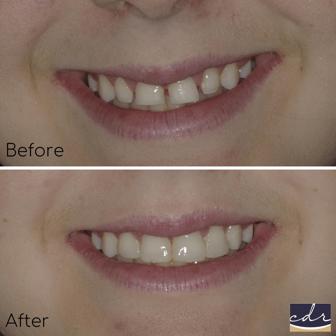 Before and After Pictures