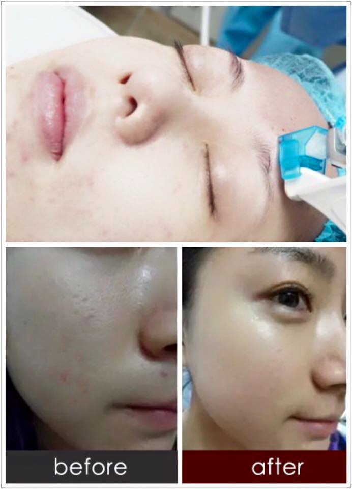 before and after a facial treatment