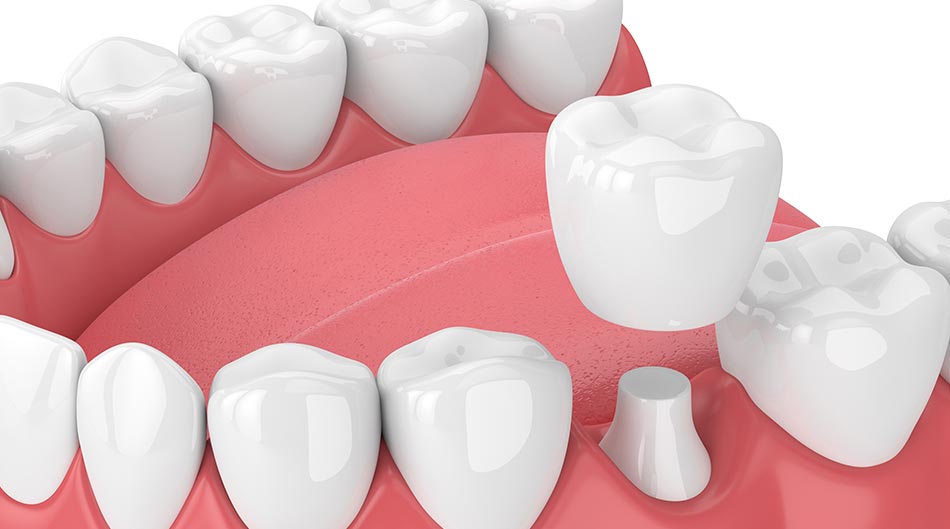 What is a Dental Crown and When is it Necessary to Get One?