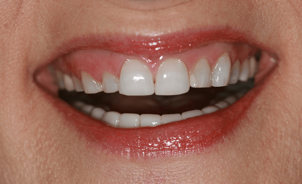Laser Gum Treatment Before & After Gallery StarImage Dentistry