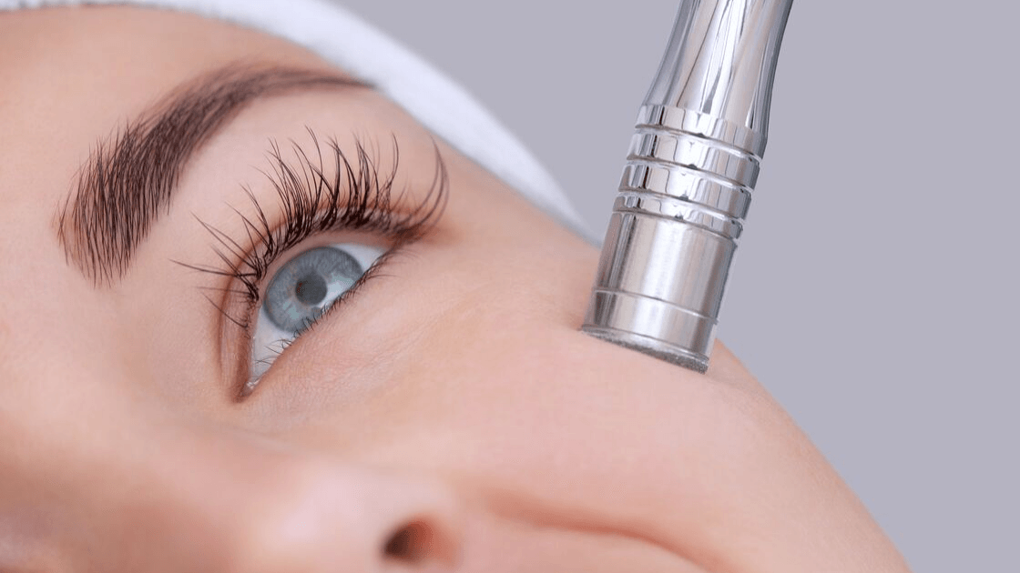 What Is Microdermabrasion?