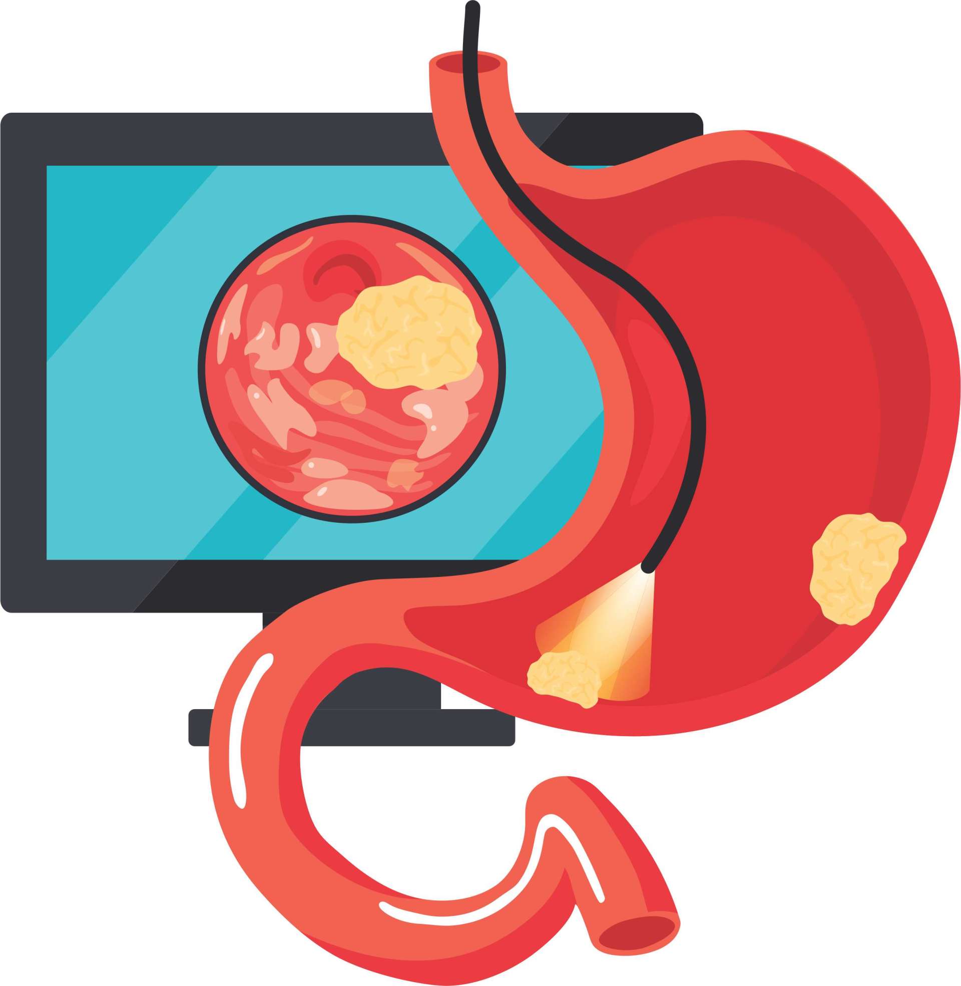 Upper GI Endoscopy Procedure, Purpose, Preparation, Cost in Hyderabad