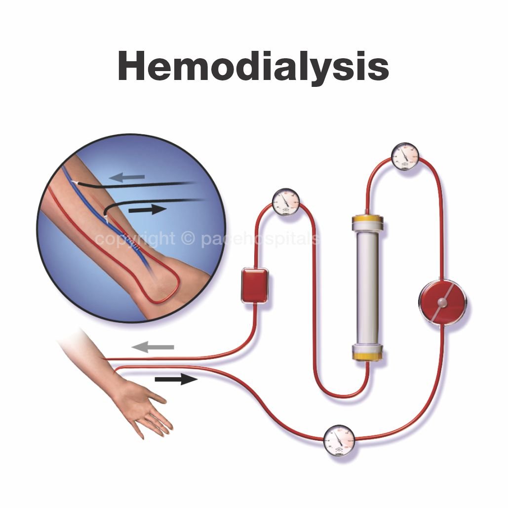 Best Dialysis Center in Hyderabad for Kidney Disease Treatment