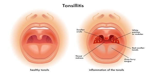 tonsillitis-is-an-infection-of-the-tonsils