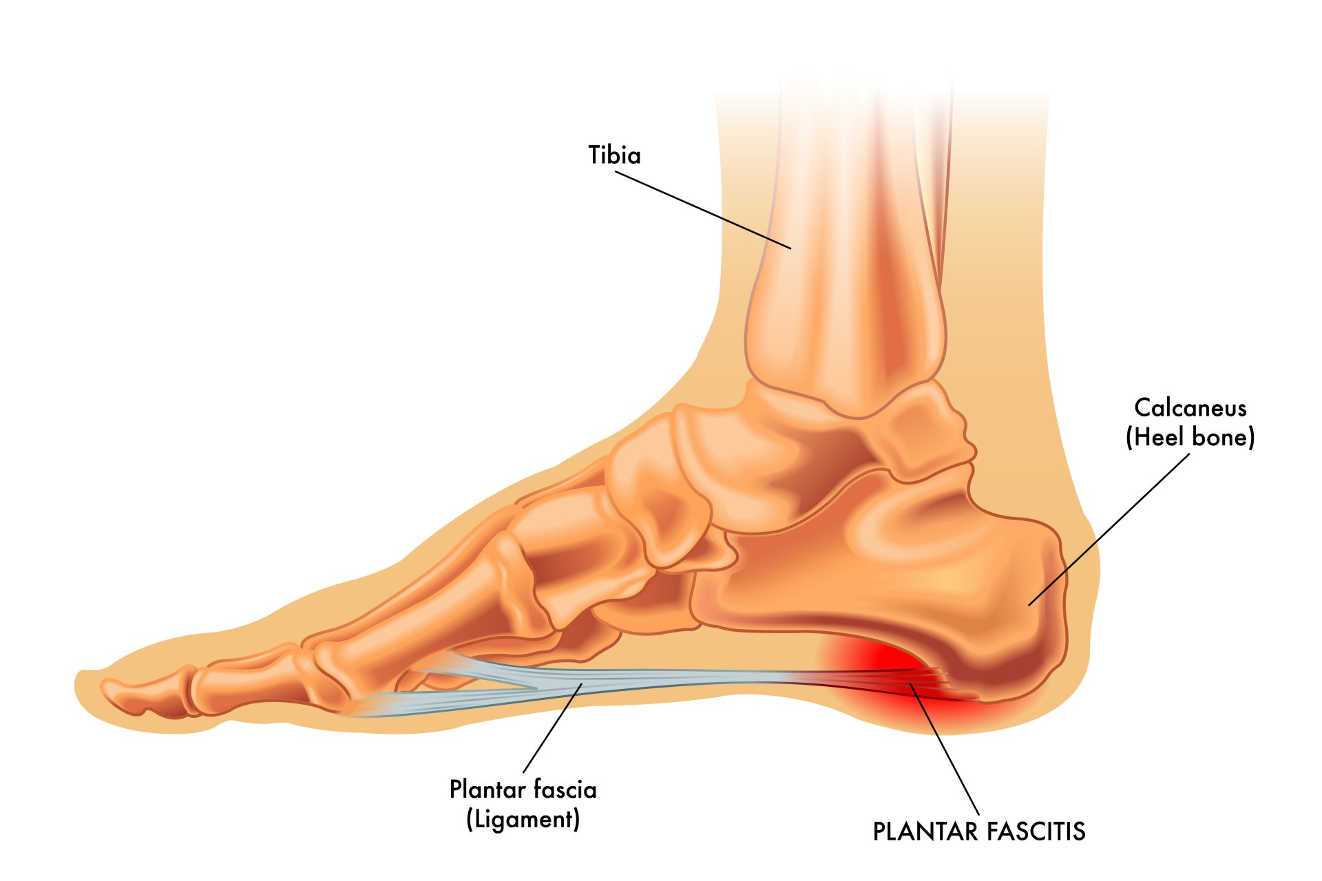 Heel Bone Back Of Foot Heel Pain After Hiking When Heel Pain Is - Main Image