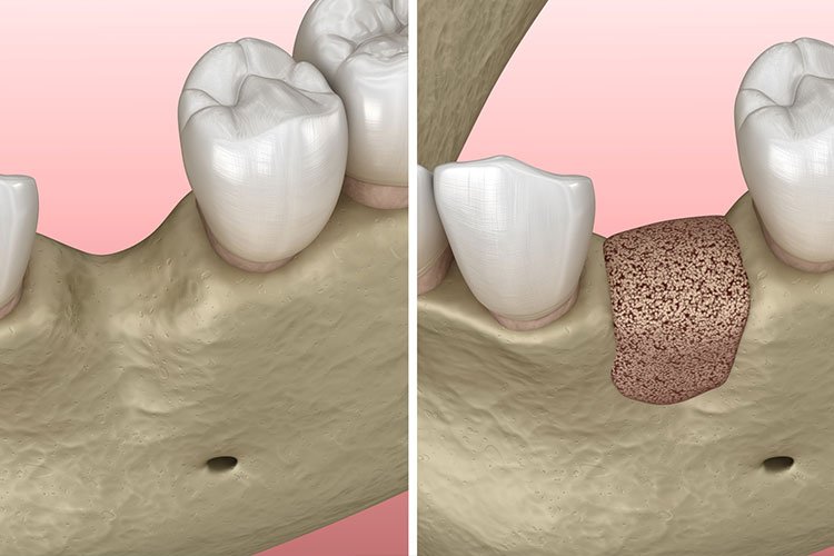 Gum & Bone Grafting In Friendswood TX Dentist 77546