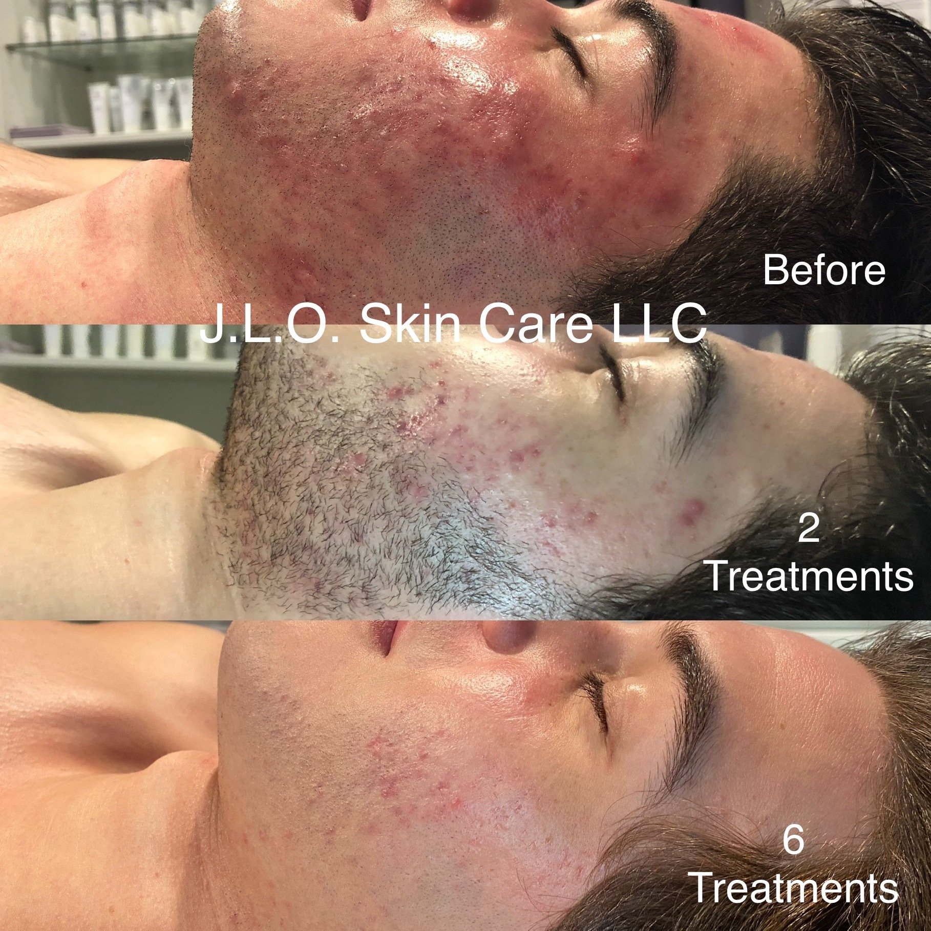 Intermediate Acne Program Acne Program | Acne Care Specialist | Phoenix, AZ