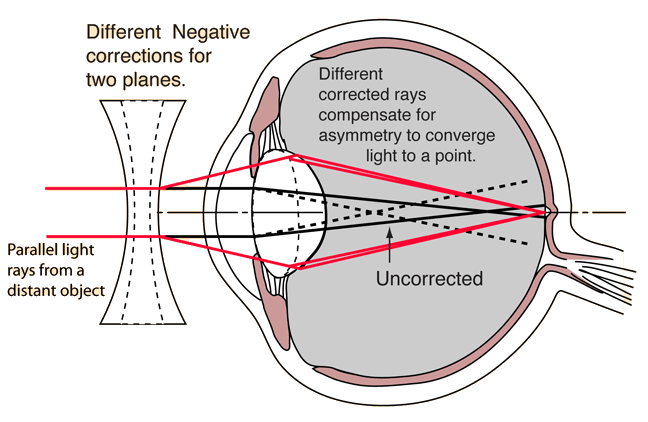 Refractive Errors | Ophthalmologist in Windermere, FL | Remagin Institute