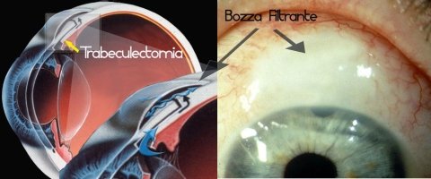 glaucoma agli occhi