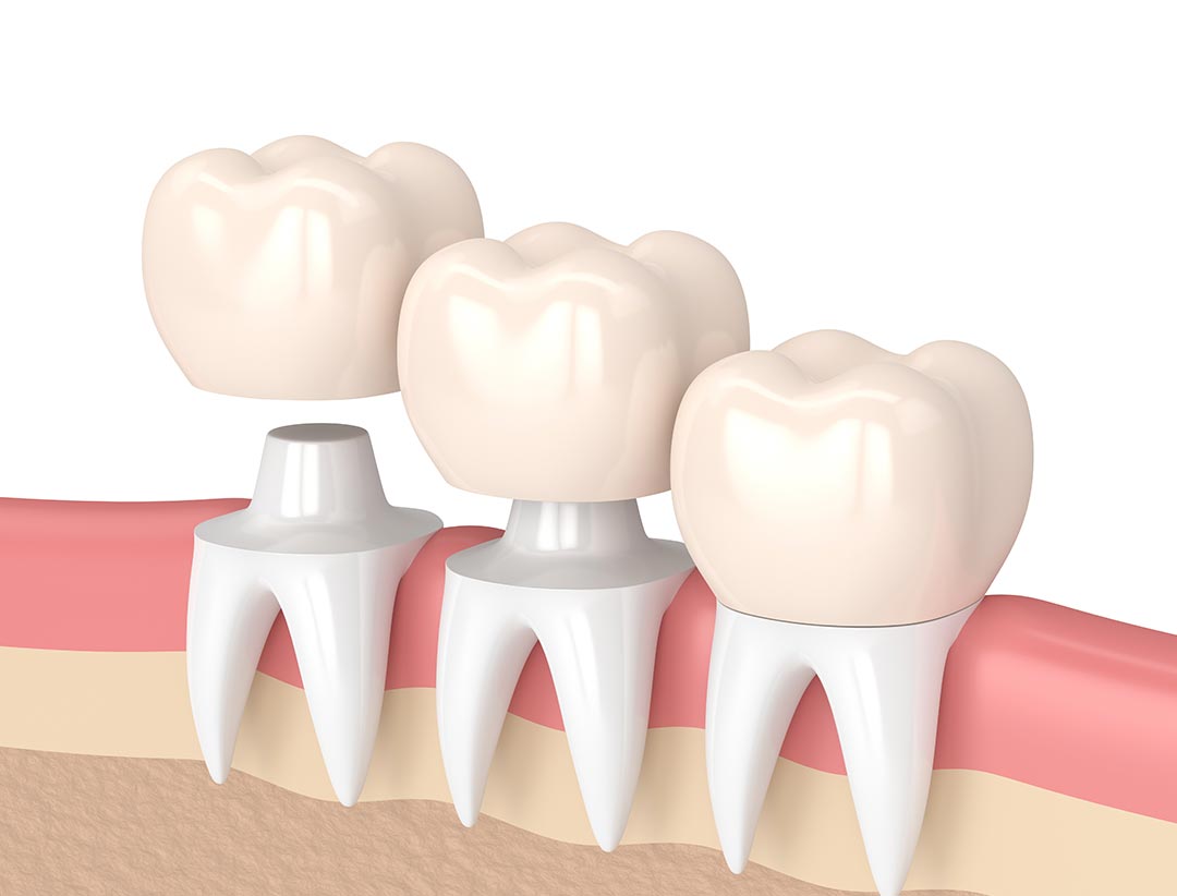 Dental Crowns North Richmond Riverlands Dental