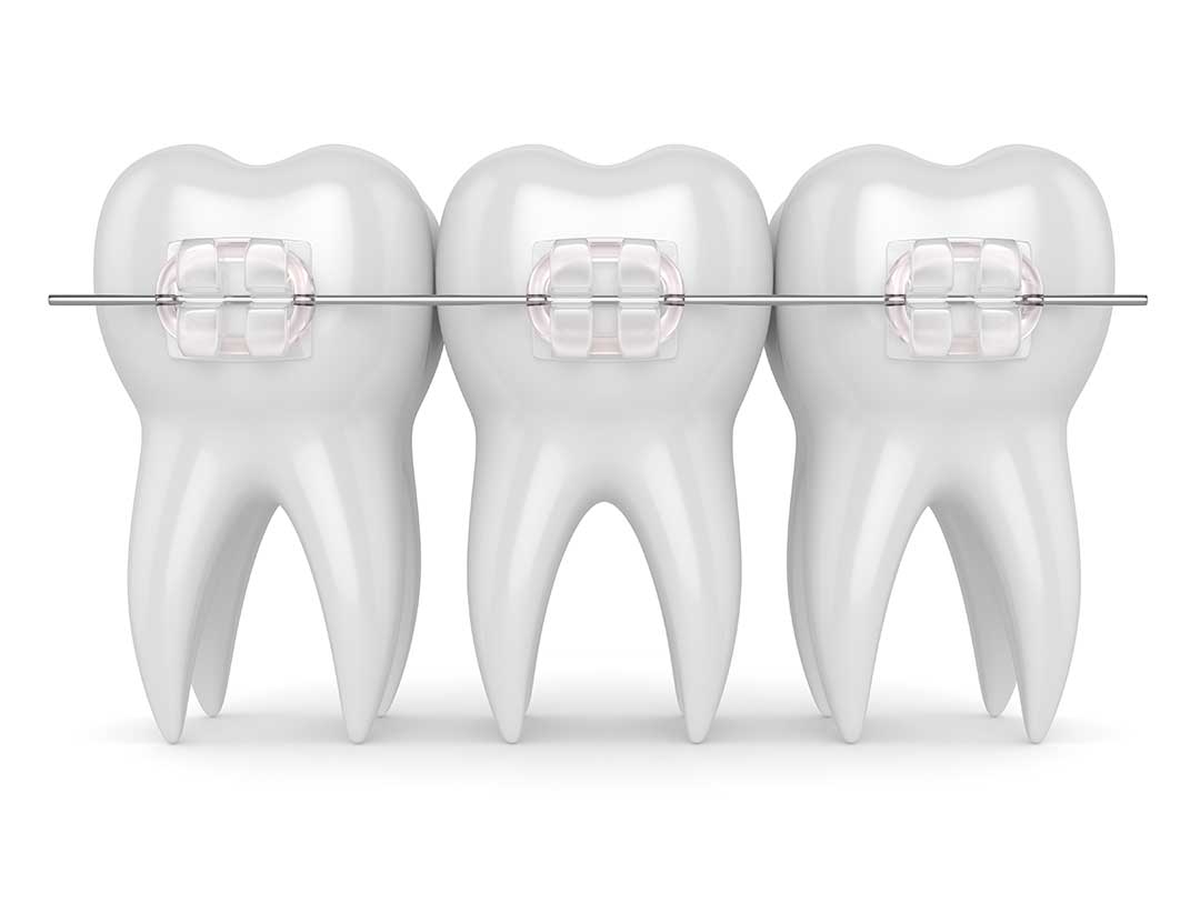 Teeth Braces North Richmond Riverlands Dental