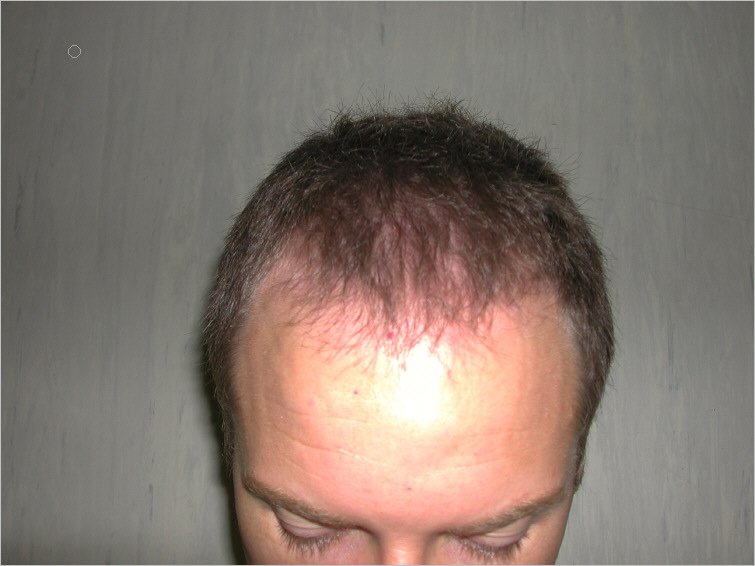 Trapianto capelli Trapianto capelli | Padova, PD | MED