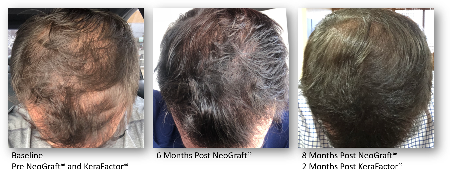Chicago, IL Keralse Treatment Procedure Dr. Yates Hair Science
