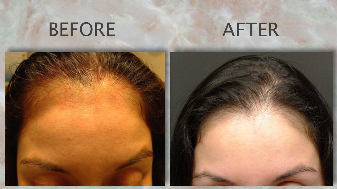 PRP Gallery PRP Hair Treatment