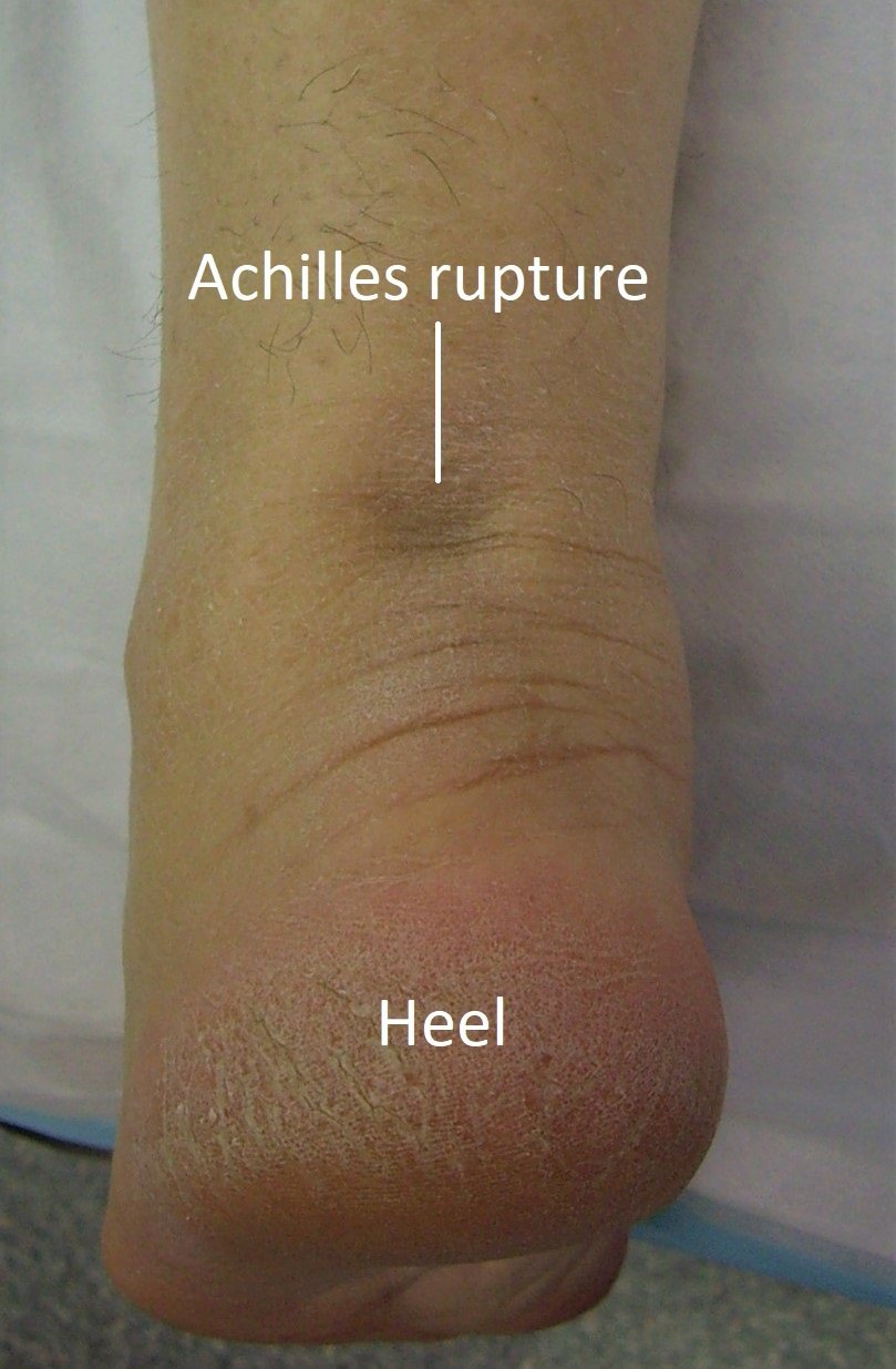 Achilles Tendon Rupture | Dr Ben Beamond | Adelaide