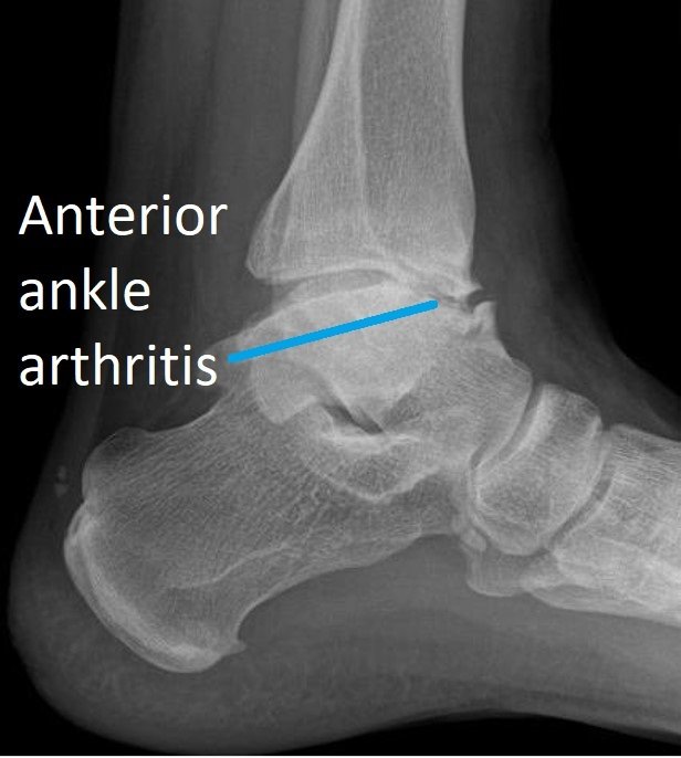 Ankle Arthritis Ankle Dr Ben Beamond Adelaide