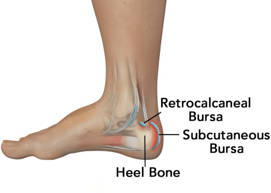 Haglund's Retrocalcaneal Bursitis Dr Ben Beamond Adelaide