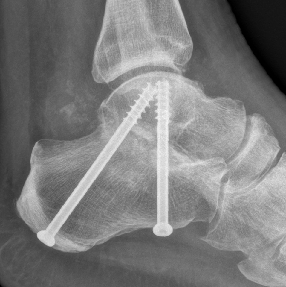 Midfoot and Hindfoot Fusion Dr Ben Beamond Adelaide