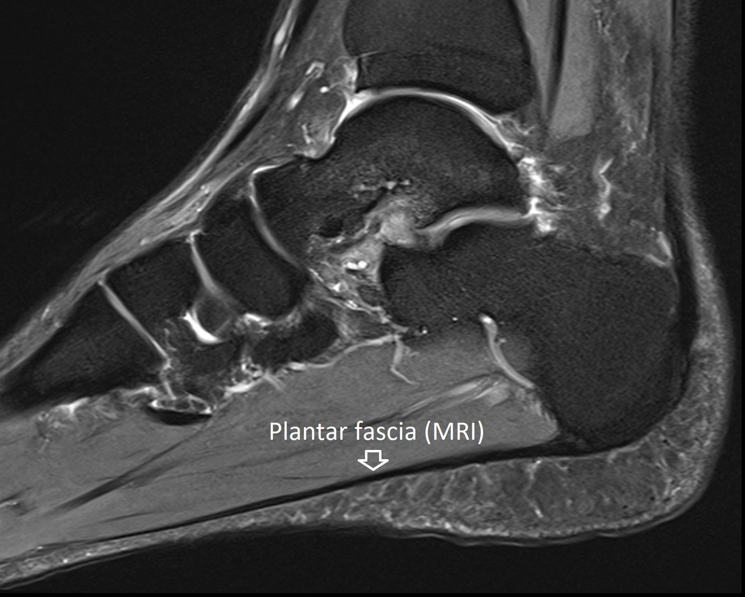 Plantar Fasciitis Dr Ben Beamond Adelaide