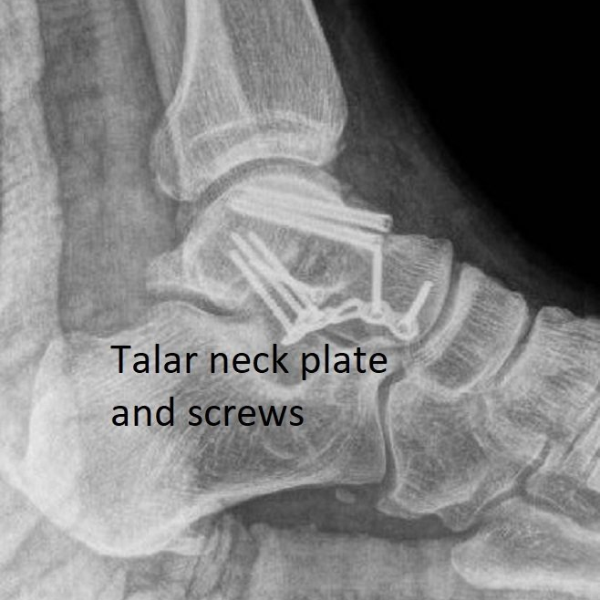 Tatus Fractures Dr Ben Beamond Adelaide