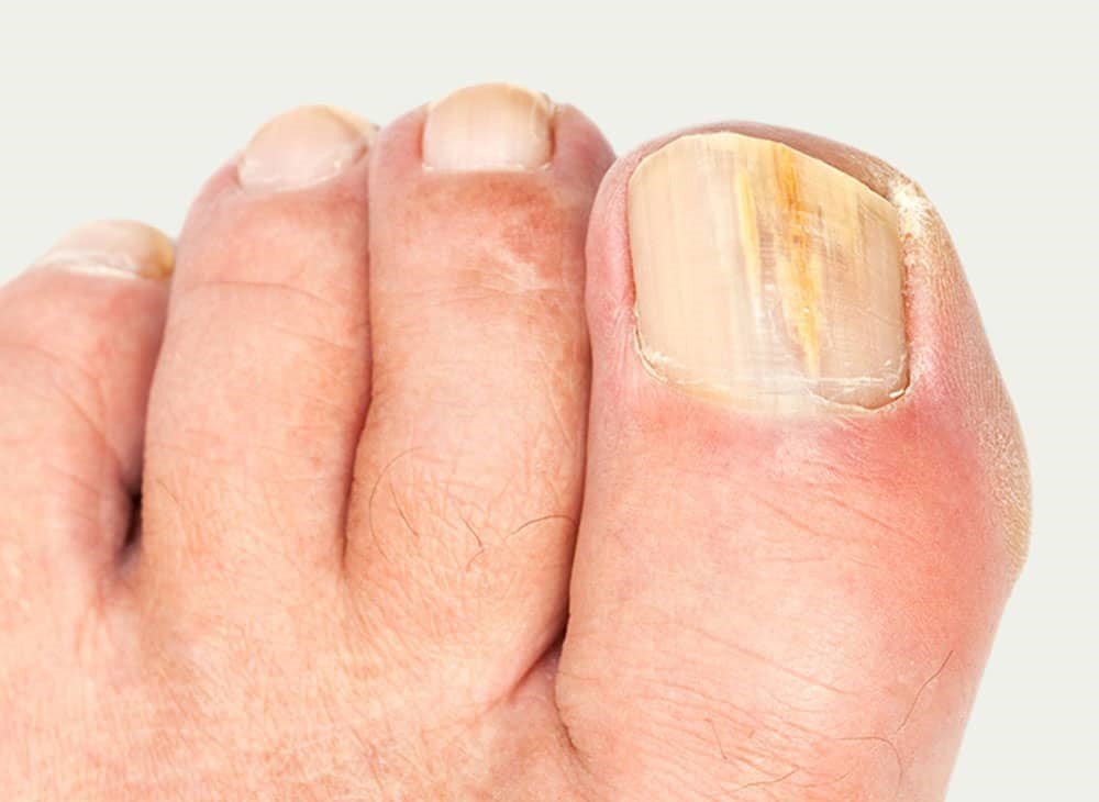 Fungal nail treatments Sally Pembery Associates