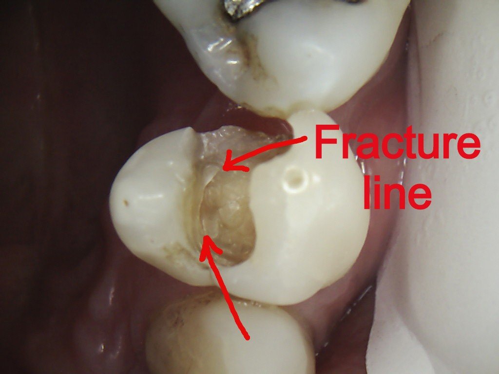 Fibre Reinforced Composite Fillings Greenwood Grincare Dentists