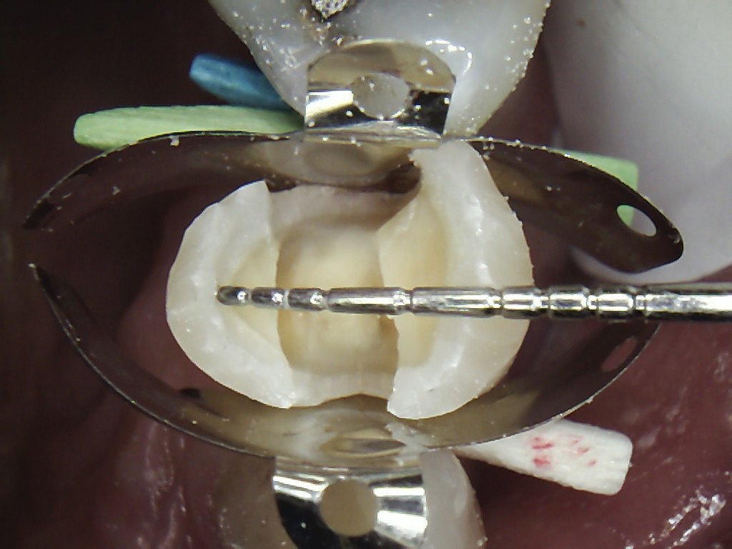Fibre Reinforced Composite Fillings Discover Dental Wellington