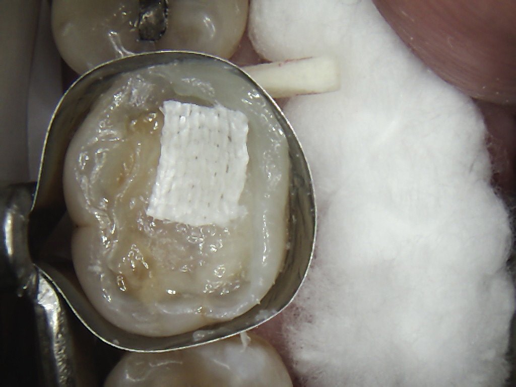 Fibre Reinforced Composite Fillings Discover Dental Wellington