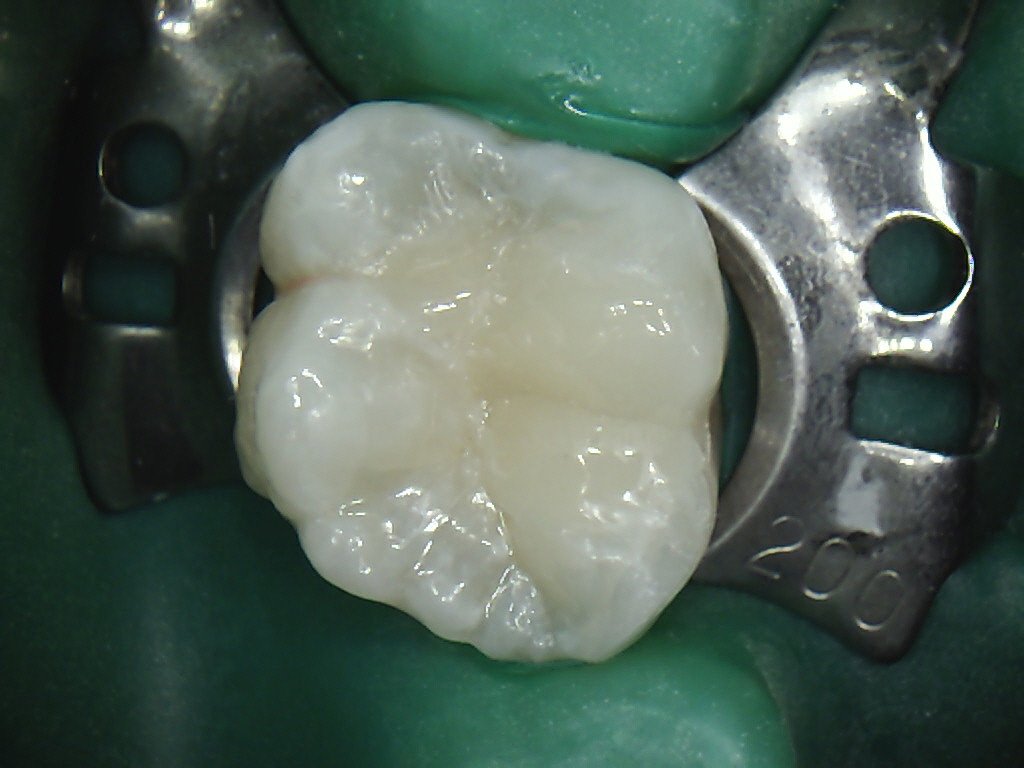 Composite Fillings Discover Dental Wellington