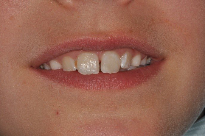 Fragmented Tooth Rebonding Fractured Tooth Fragments | Discover Dental Wellington
