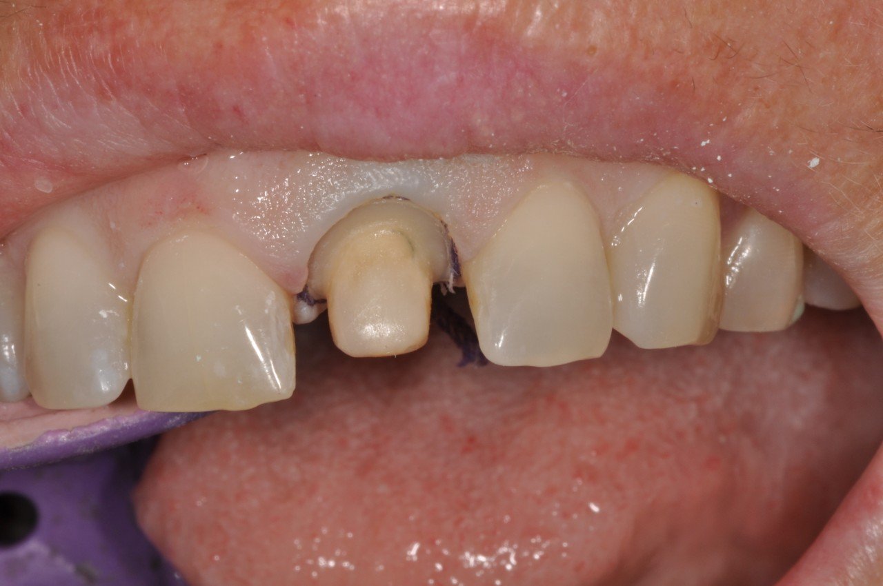 Crowns & Onlays Greenwood Grincare Wellington Dentists