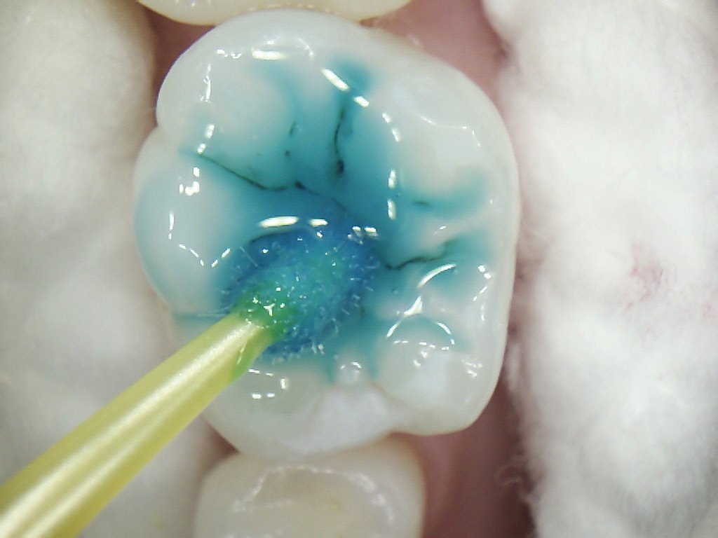 Fissure Protection & PRRs Greenwood Grincare Wellington Dentists