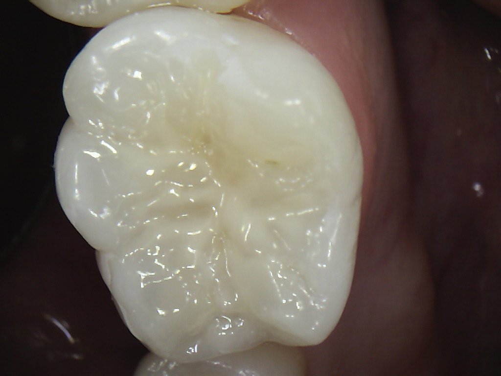 Fissure Protection & PRRs Discover Dental Wellington