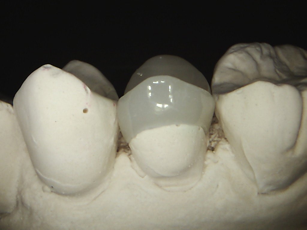 Crowns & Onlays Greenwood Grincare Wellington Dentists