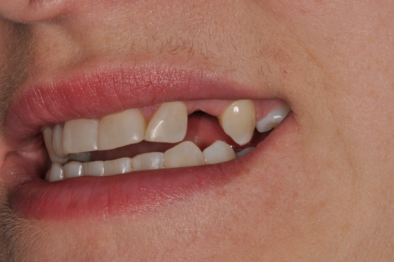 Resin Bonded Bridges Discover Dental Wellington