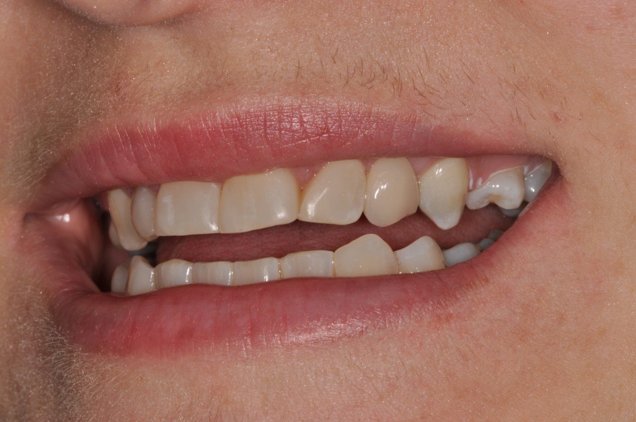 Resin Bonded Bridges Discover Dental Wellington